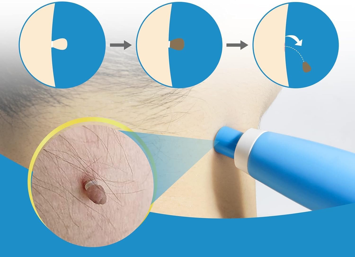 Kit Indolor para Remoção de Ve - Health Wellness avaliação e preço